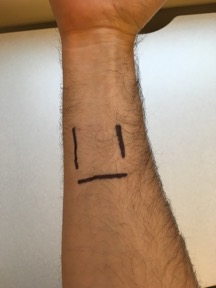 three line ink smiley face on arm.