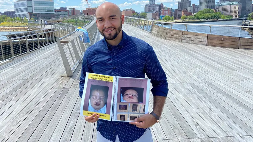 Bentley grad spreads hope and awareness about cleft and craniofacial disorders